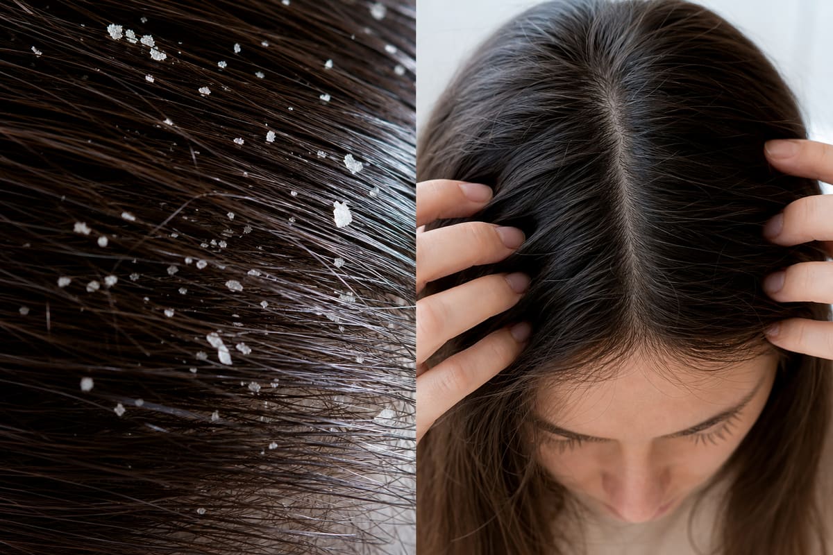 Comparaison macro entre pellicules détachées et cheveux, pour distinguer poux et pellicules